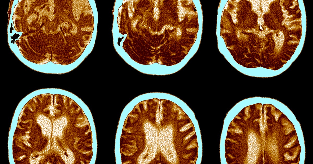 Why knowing when Alzheimer’s starts could lead to new treatments