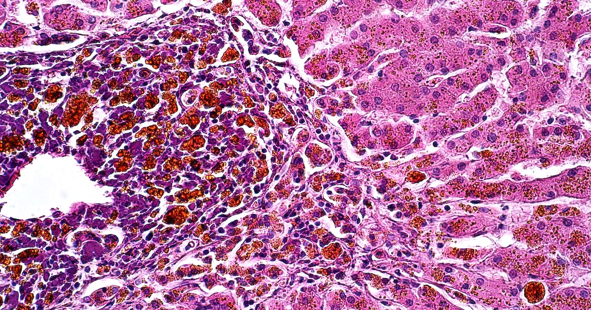 Vinyl Chloride Exposure May Have Similar Liver Effects to Heavy Drinking