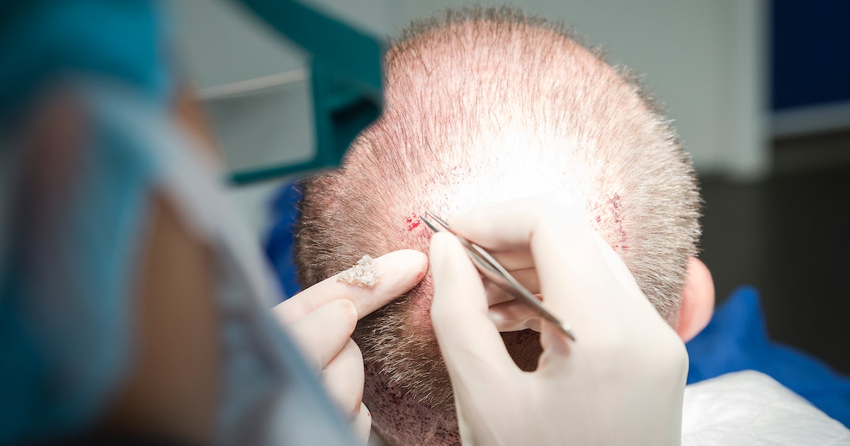 Hairy Moles Could Actually Hold the Cure for Baldness